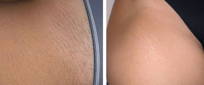 Bikinizone – nach der Behandlung